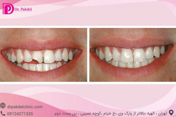 Dental composite-5