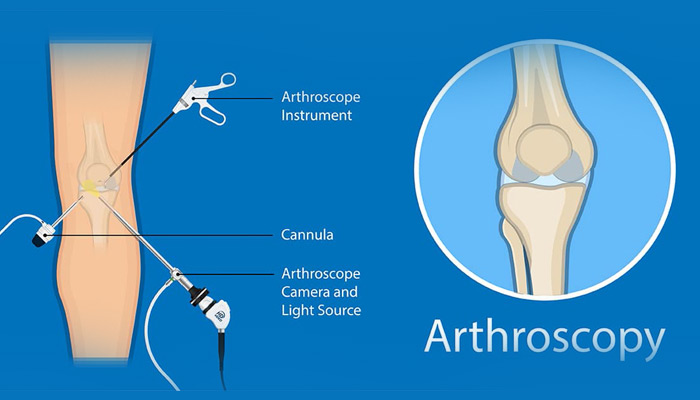 جراحی آرتروسکوپی زانو