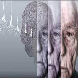 تشخیص زود هنگام آلزایمر