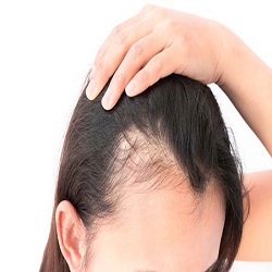 اثر استرس بر ریزش مو چیست؟