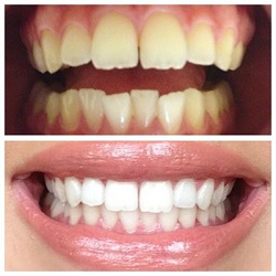 آشنایی با روش های سفید کردن دندان