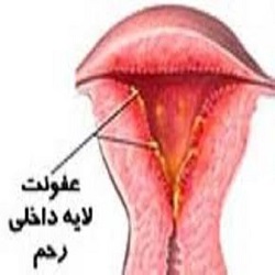چگونه می‌توان از عفونت واژن جلوگیری کرد؟