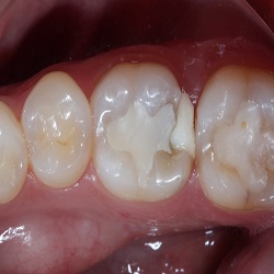 معایب پانسمان موقت دندان چیست؟