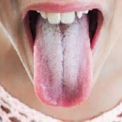 علت سفیدی زبان و درمان های خانگی آن چیست؟