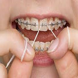 آیا در زمان ارتودنسی از نخ دندان می توان استفاده کرد و چگونه ؟