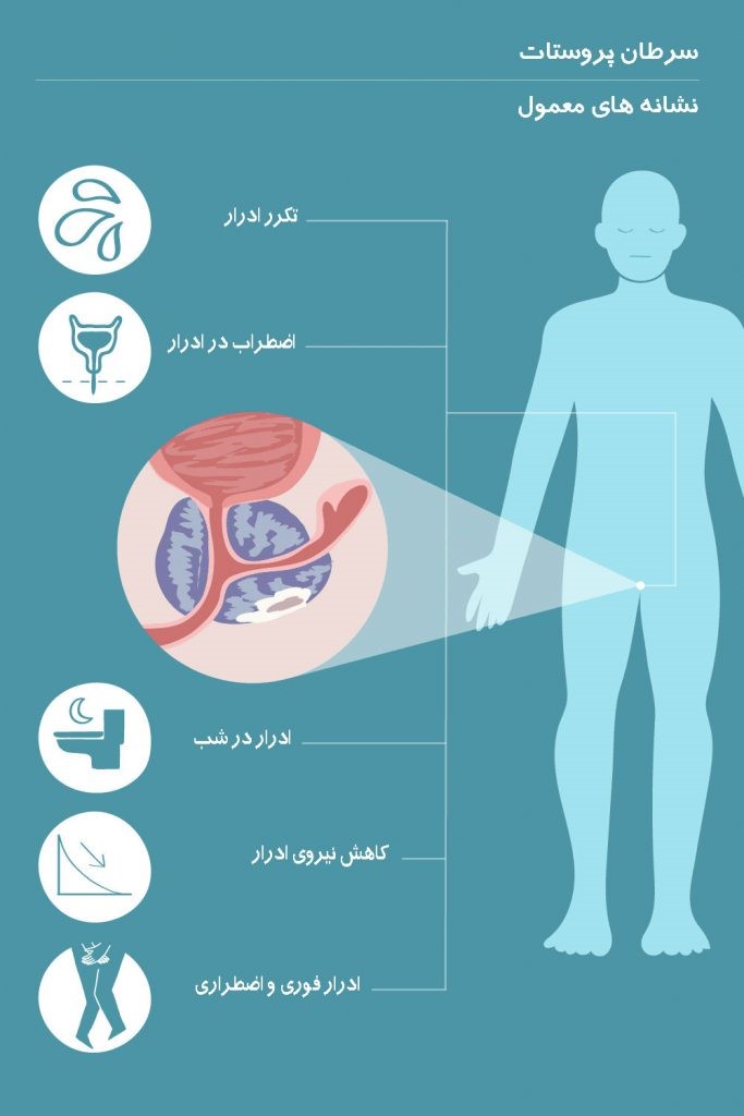 سرطان پروستات